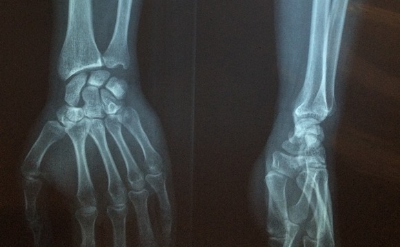Guardian FS withdraws 'unsustainable' fracture cover